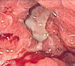 <b>Peptic ulcer</b> - Wikipedia