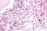 File:Pulmonary <b>aspergillosis</b>.