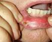<b>BOCA</b> - DERMATOLOGIA ORAL