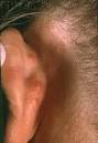 <b>Angiolymphoid Hyperplasia</b> With <b>Eosinophilia</b>; Kimura Disease