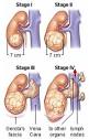 <b>Tumor de Wilms</b>, também chamado