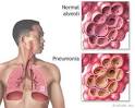 Pneumonia - Adults (Community Acquired) - Symptoms, Diagnosis.