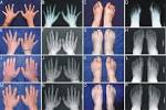 Underlie <b>Syndactyly</b> Type V