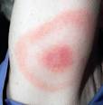 <b>Borrelia Burgdorferi</b> diagnosis