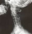 <b>klippel feil syndrome</b> neck