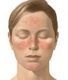 <b>Rosacea</b>