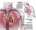 What is <b>angina pectoris</b>?