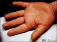 Kawasaki's disease - edema of the hand: MedlinePlus Medical ...