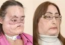 Global Rumblings: First U.S. Face Transplant Donor Revealed