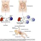 "<b>Erythroblastosis</b>, <b>Fetal</b>"