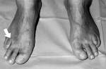 <b>Refsum's disease</b> in an Arabian