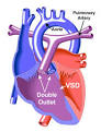 <b>Double Outlet Right Ventricle</b>