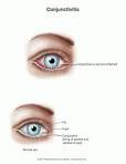 <b>Eye Infection</b>, <b>Bacterial</b>