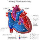 <b>Double Outlet Right Ventricle</b>