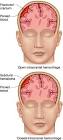 <b>Intracranial Hemorrhage</b>