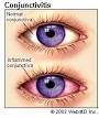 <b>Conjunctivitis</b>. Bacteria.
