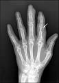 <b>Gout</b>: An Update - September 15, 2007 - American Family Physician