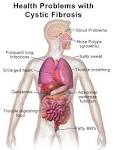 Cystic fibrosis - Wikipedia, the free encyclopedia