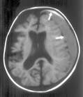 region and <b>acute subdural</b>