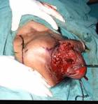 Squamous cell carcinoma of the scrotum