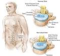 Treatment Options for a HERNIATED DISC « Patients Crossing Oceans