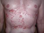 File:Grover's <b>disease</b>