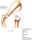 <b>Osteochondritis Dissecans</b>