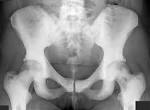 dense <b>osteosclerosis</b> could
