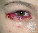 Herpes Simplex <b>Eye Disease</b>