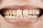 <b>Tooth Discoloration</b> – Yellow <b>Teeth</b> Prevention, Treatment / Periclean