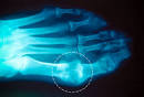<b>Gout</b> Pictures Slideshow: Causes, Symptoms, and Treatments of <b>Gout</b>