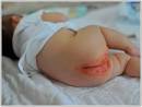 <b>Diaper rash</b>