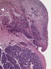 Ovary - nontumor - Mixed <b>gonadal dysgenesis</b>