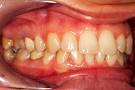 What is the definition or description of: <b>Tooth discoloration</b>