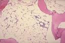 than <b>aplastic anemia</b>.