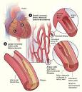 coronary <b>microvascular</b> disease
