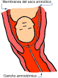 UNIDAD MEDICA SAN JUAN Ginecoobstetricia: <b>RUPTURA PREMATURA</b> DE