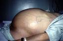 Pictures of <b>Ascites</b> :