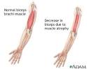 <b>Muscular</b> atrophy