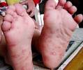 Hand, foot, and <b>mouth disease</b>