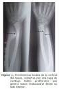 Revista Cubana de Pediatría - Exostosis cartilaginosa múltiple