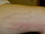 Superficial <b>thrombophlebitis</b>