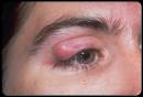 Picture of Chalazion (<b>Eyelid</b>
