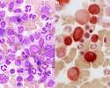 <b>Chronic myelomonocytic</b>