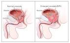 <b>Neoplasias</b> de <b>la Próstata</b>