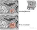 Prostate Cancer - Symptoms, Diagnosis, Treatment of Prostate.