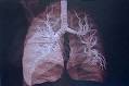 <b>Placenta</b> breakthrough may