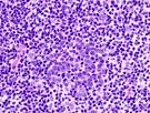 File:<b>Diffuse</b> large B cell