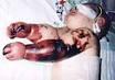 <b>Meningococcal disease</b>