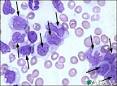 Acute <b>Myelomonocytic Leukemia</b>